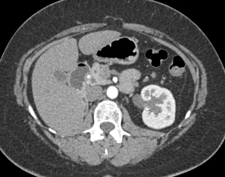 Multifocal Transitional Cell Carcinoma (TCC) Left Ureter - CTisus CT Scan