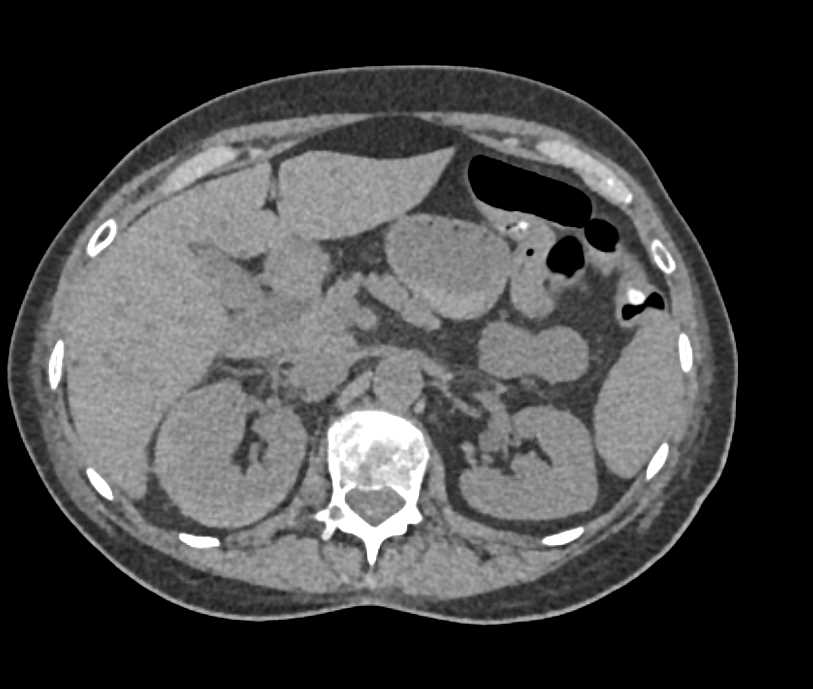 Right Perirenal Hematoma - CTisus CT Scan