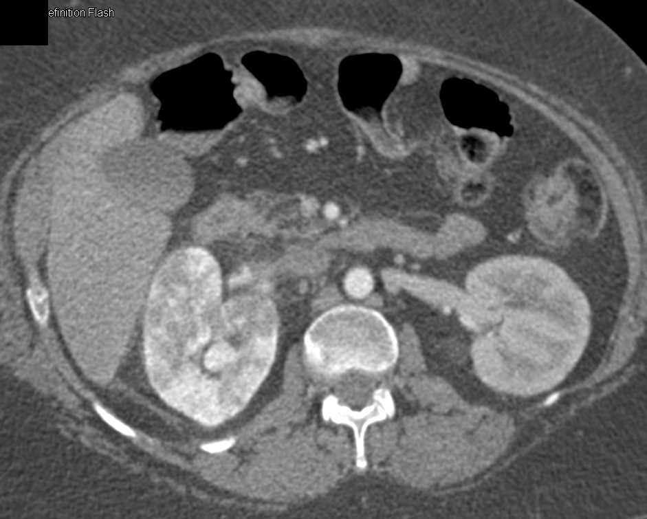 Acute Pyelonephritis Right Kidney - CTisus CT Scan