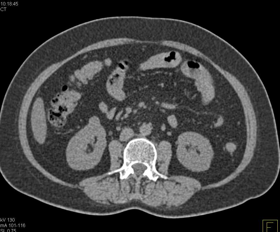 1cm Right Renal Cell Carcinoma (CC-RCC) - CTisus CT Scan