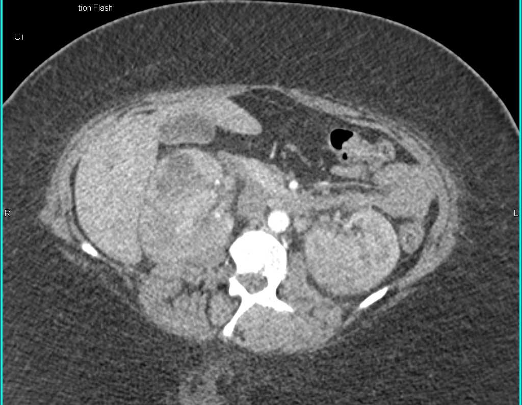 Acute Pyelonephritis Both Kidneys - CTisus CT Scan