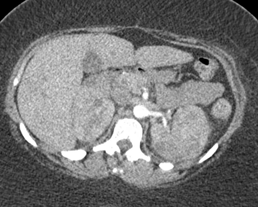 Renal Lymphoma Involves Both Kidneys - CTisus CT Scan