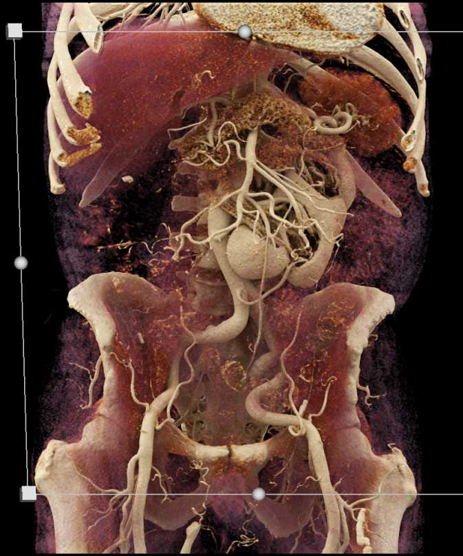 Crossed Renal Ectopia - CTisus CT Scan