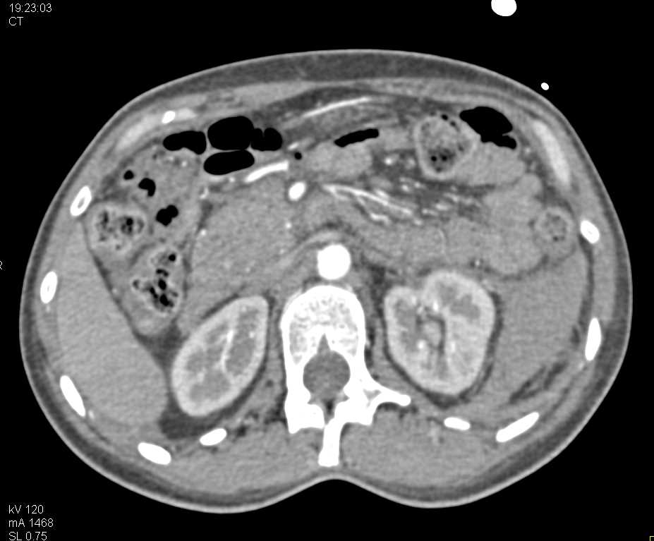 Pararenal Space Bleed Left Kidney - CTisus CT Scan