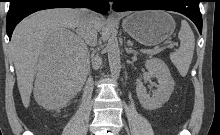 Cystic Renal cell carcinoma - CTisus CT Scan