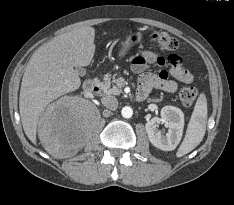Cystic Renal cell carcinoma - CTisus CT Scan
