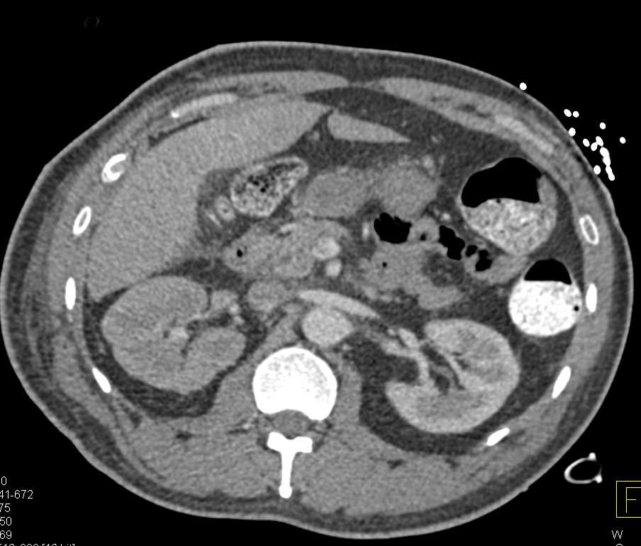Delayed Function Right Kidney - CTisus CT Scan