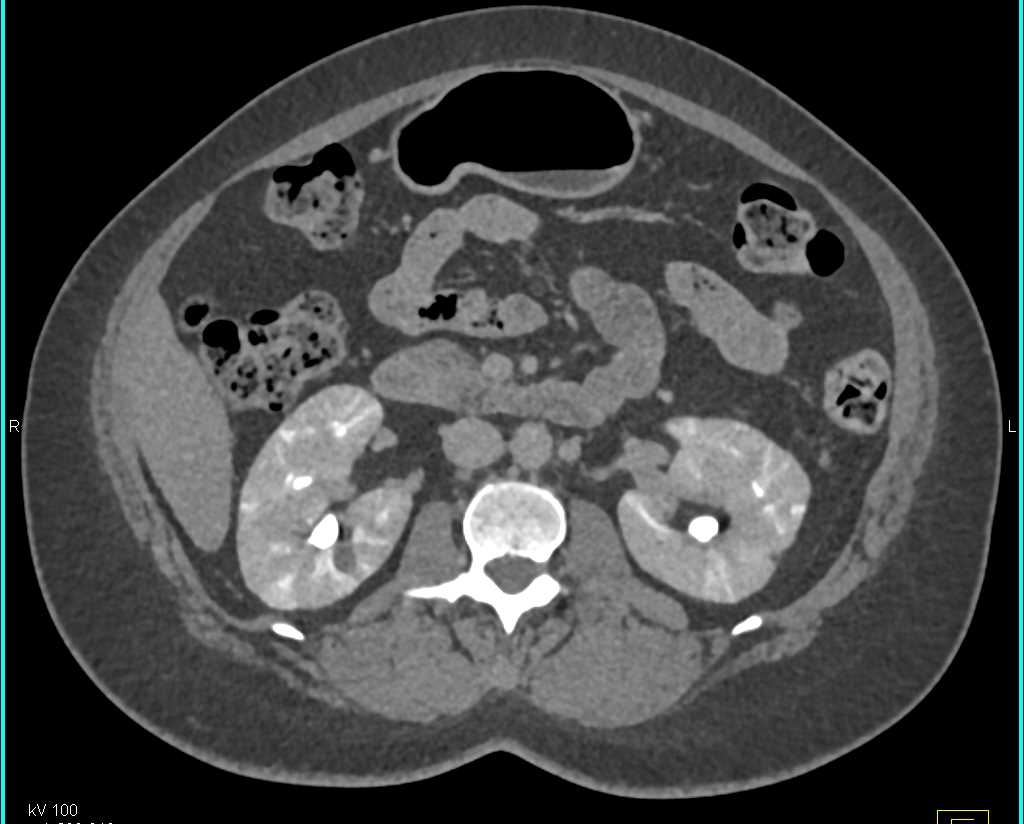 Patchy Enhancement Kidneys due to Renal Failure - CTisus CT Scan