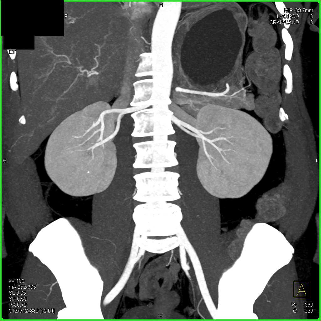 Patchy Enhancement Kidneys due to Renal Failure - CTisus CT Scan