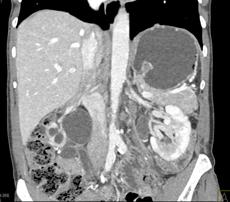 Acute Pyelonephritis Left Kidney - CTisus CT Scan