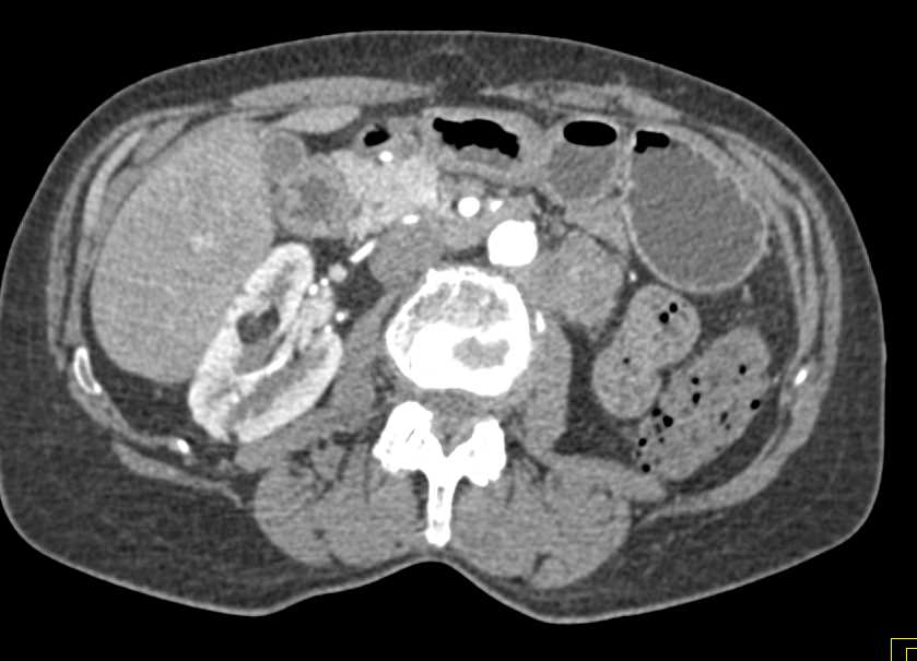 Multiple Myelolipomas (AML) Right Kidney - CTisus CT Scan