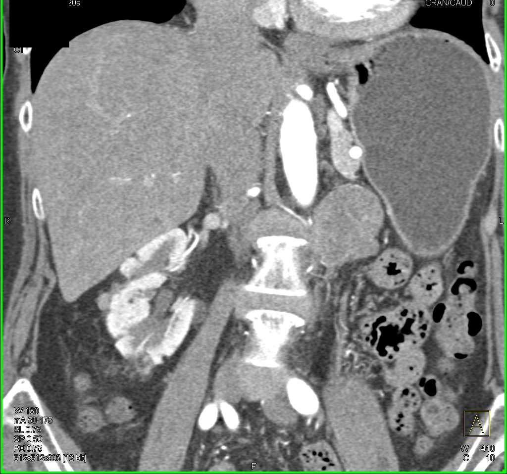 Multiple Myelolipomas (AML) Right Kidney - CTisus CT Scan