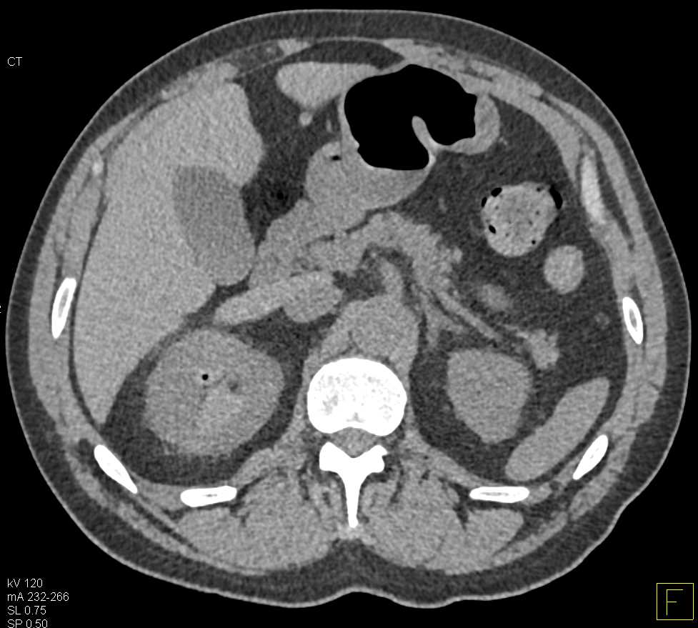 Bilateral Renal Calculi with Right Sided Bleed - CTisus CT Scan