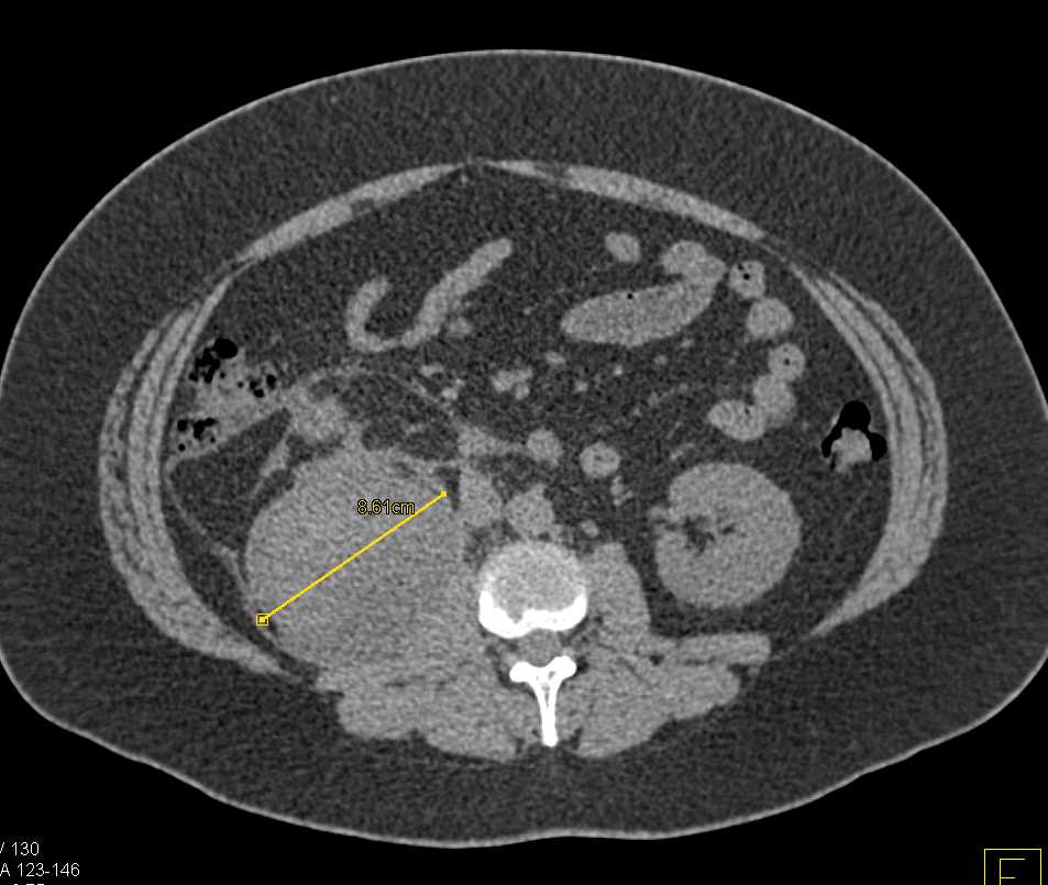 Perirenal Hematoma - CTisus CT Scan