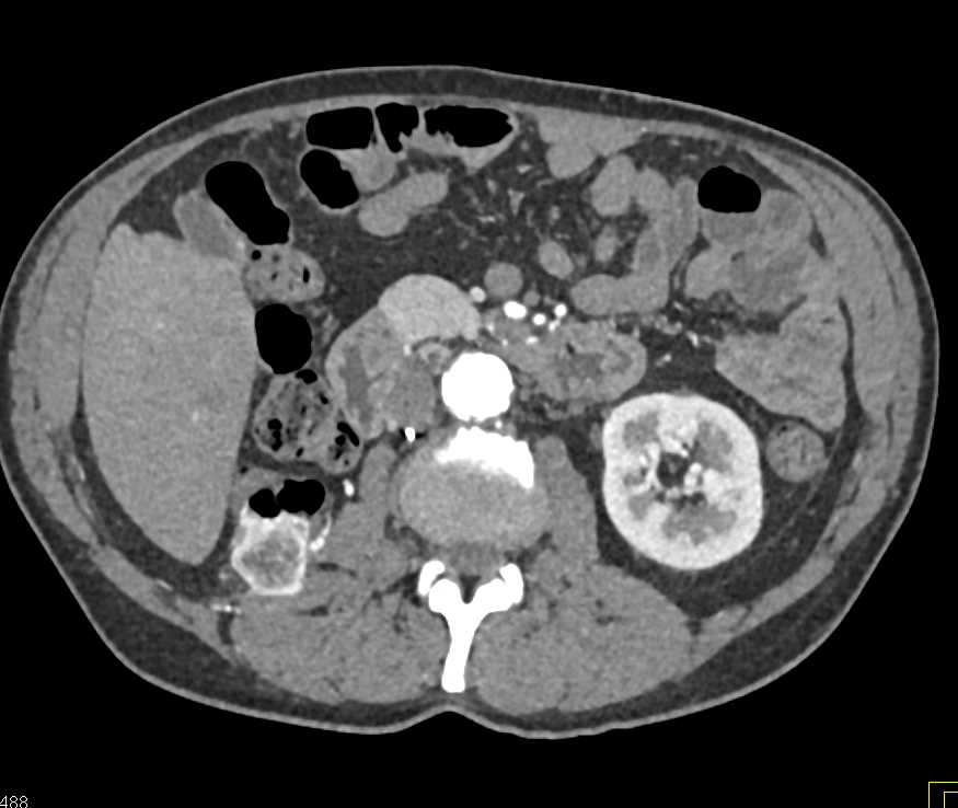 Recurrent Renal Cell Carcinoma in Nephrectomy Bed - CTisus CT Scan