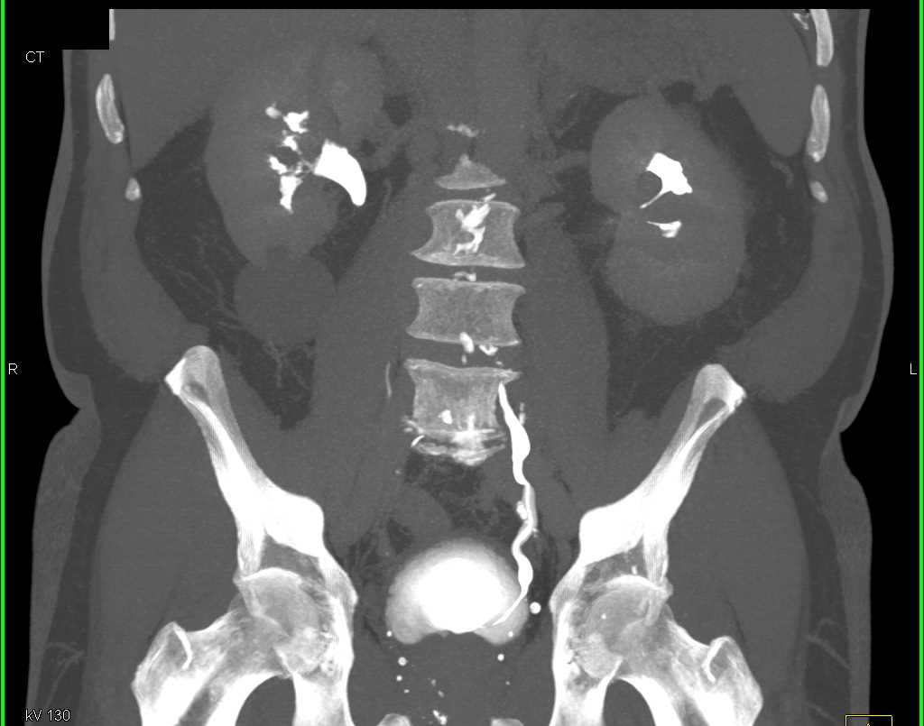 Multifocal Transitional Cell Carcinoma (TCC) Involves Kidney and Ureter - CTisus CT Scan