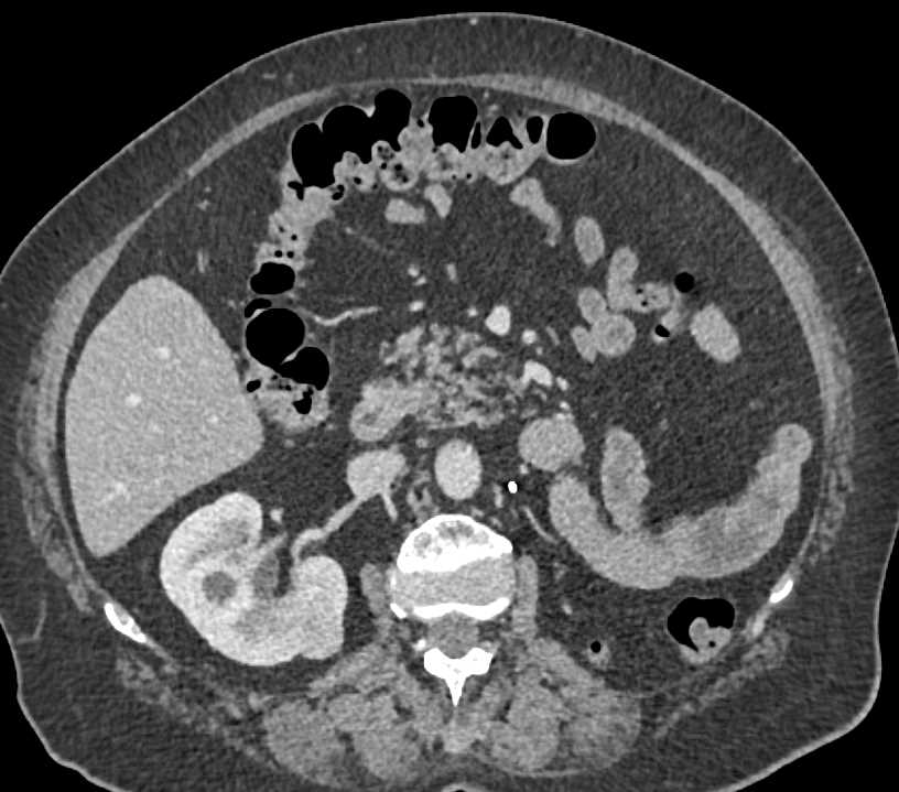 Renal Cell Carcinoma with Bowel, Pancreas and Mediastinal Metastases - CTisus CT Scan