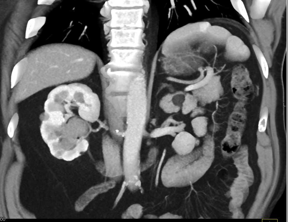 Transitional Cell Carcinoma Right Kidney - CTisus CT Scan