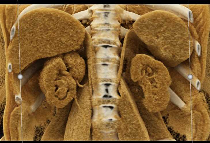 Transitional Cell Carcinoma Right Kidney and Bladder - CTisus CT Scan