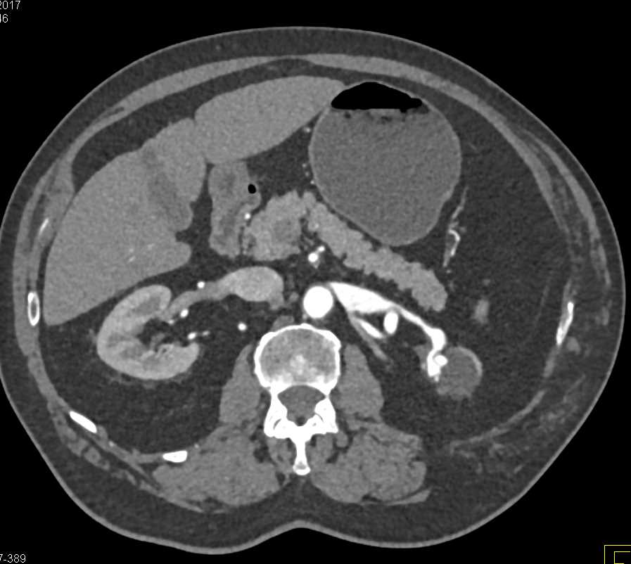 AV Fistulae Left Kidney - CTisus CT Scan