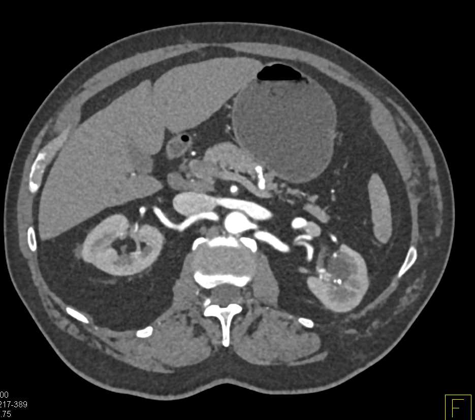 AV Fistulae Left Kidney - CTisus CT Scan