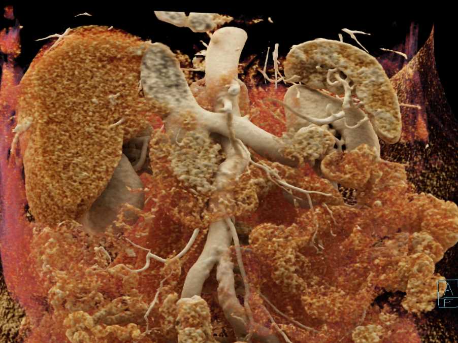 AV Fistulae Left Kidney - CTisus CT Scan