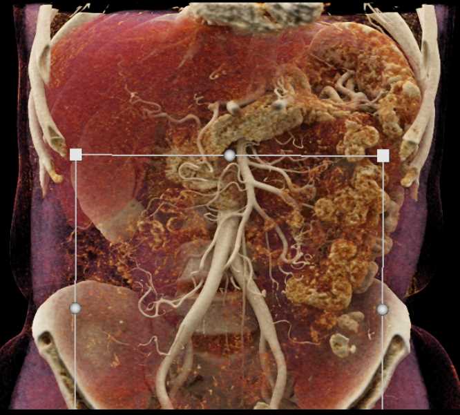 Renal Cell Carcinoma Upper Pole Right Kidney - CTisus CT Scan