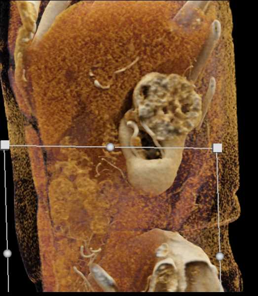 Renal Cell Carcinoma Upper Pole Right Kidney - CTisus CT Scan