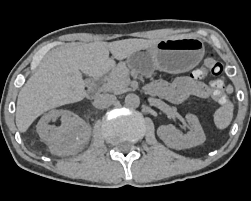 Renal Cell Carcinoma Upper Pole Right Kidney - CTisus CT Scan