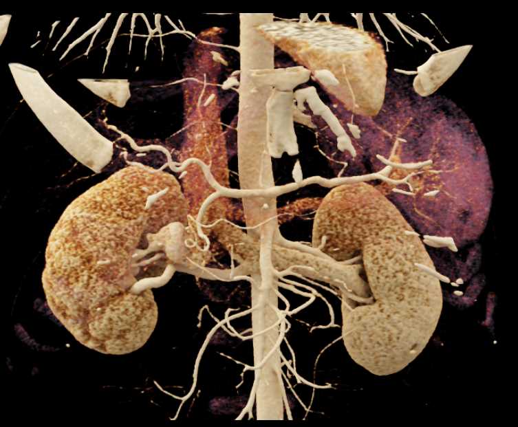 AV Fistulae Right Kidney with Cinematic Rendering - CTisus CT Scan