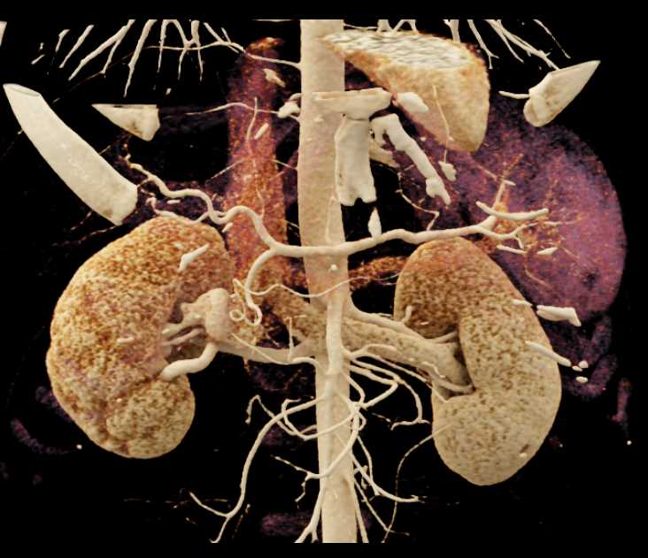 AV Fistulae Right Kidney with Cinematic Rendering - CTisus CT Scan