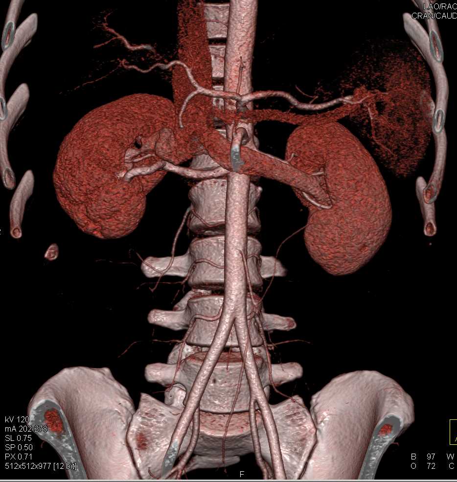 AV Fistulae Right Kidney - CTisus CT Scan