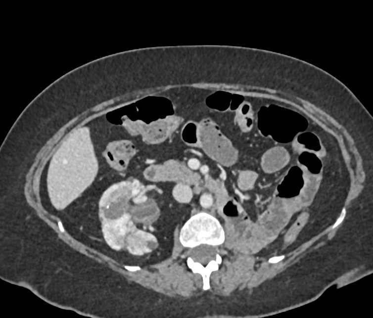 Renal Cell Carcinoma Right Kidney - CTisus CT Scan