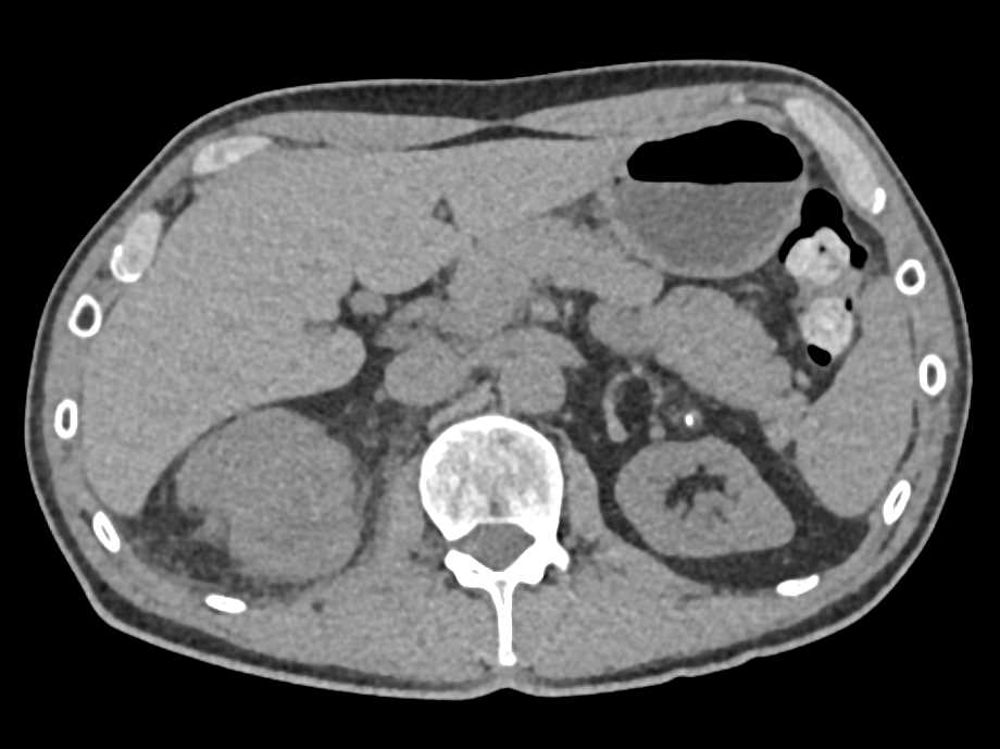 Renal Cell Carcinoma Upper Pole Right Kidney - CTisus CT Scan