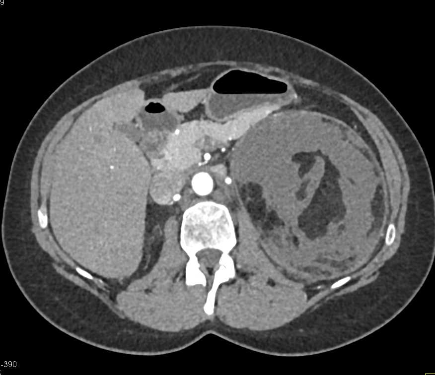 Bleed in Angiomyolipoma Upper Pole Left Kidney - CTisus CT Scan