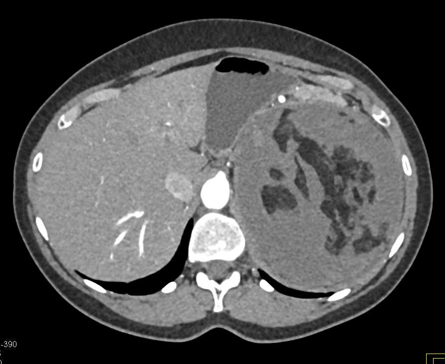 Bleed in Angiomyolipoma Upper Pole Left Kidney - CTisus CT Scan