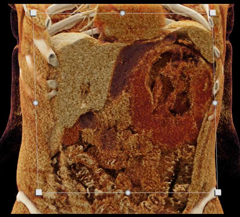 Bleed in Angiomyolipoma Upper Pole Left Kidney - CTisus CT Scan