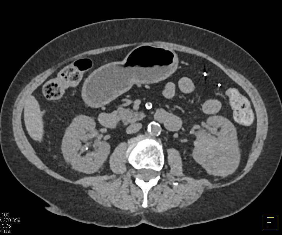 Clear Cell RCC Invades Left Renal Vein and Inferior Vena Cava (IVC) - CTisus CT Scan