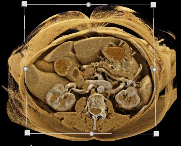 Clear Cell RCC Invades Left Renal Vein and Inferior Vena Cava (IVC) - CTisus CT Scan