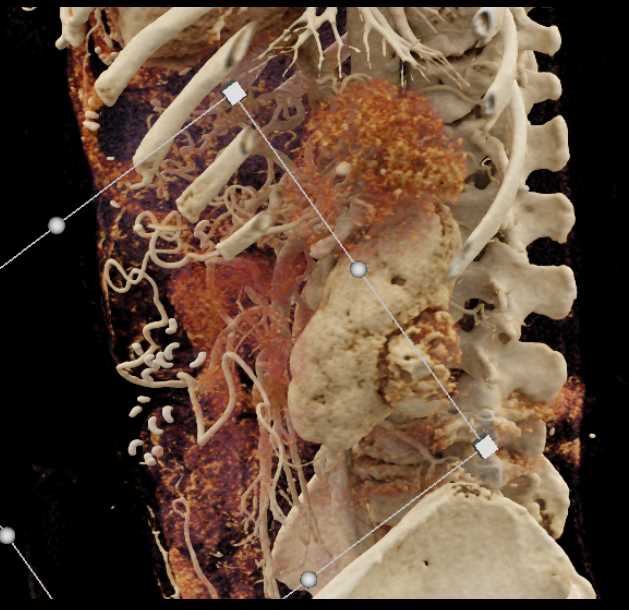 Clear Cell RCC Invades Left Renal Vein and Inferior Vena Cava (IVC) - CTisus CT Scan