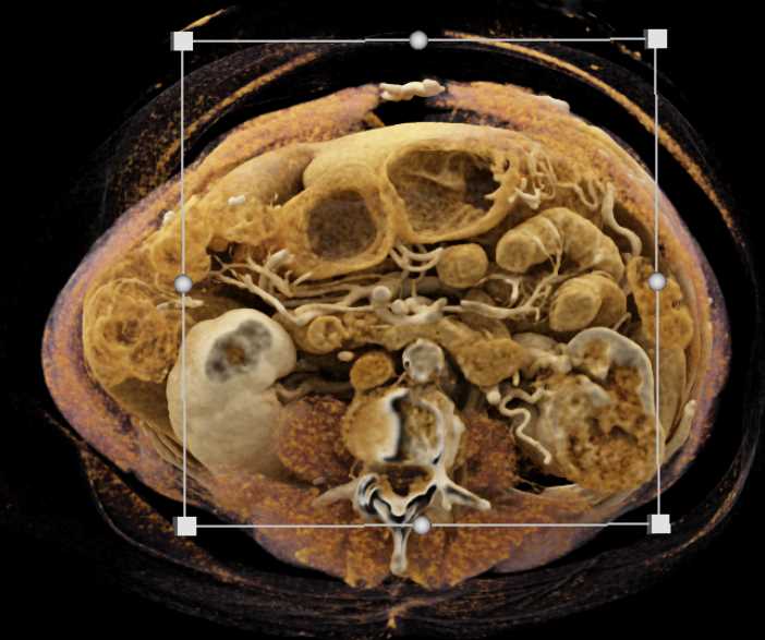 Clear Cell RCC Invades Left Renal Vein and Inferior Vena Cava (IVC) - CTisus CT Scan