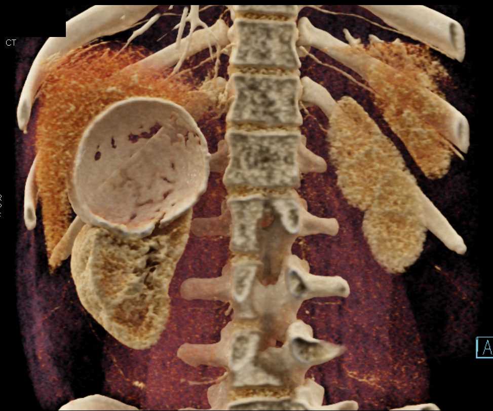 Calcified Cyst Right Kidney - CTisus CT Scan