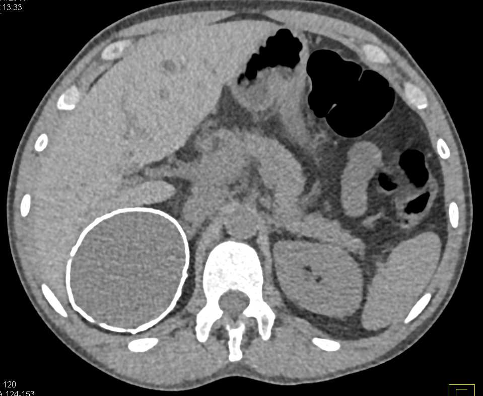 Calcified Cyst Right Kidney - CTisus CT Scan