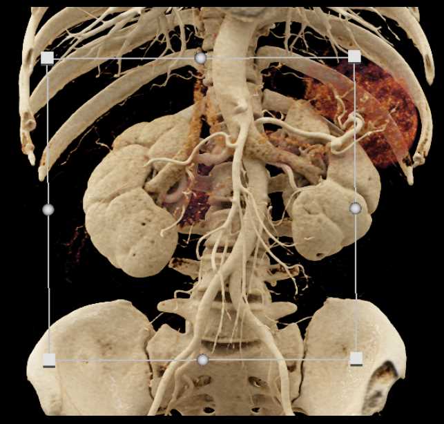 Fibromuscular Dysplasia Involves the Right Renal Artery - CTisus CT Scan