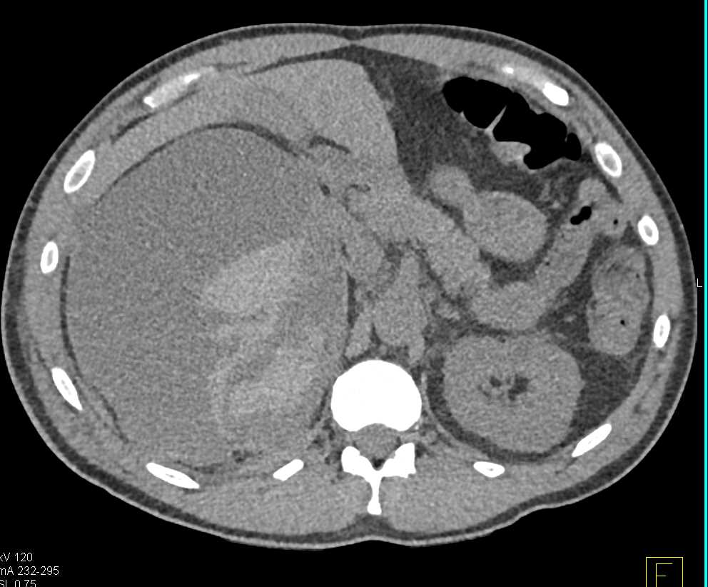 Spontaneous Right Renal Bleed in an Angiomyolipoma (AML) - CTisus CT Scan