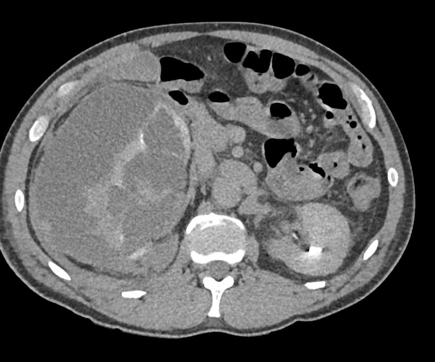 Spontaneous Right Renal Bleed in an Angiomyolipoma (AML) - CTisus CT Scan