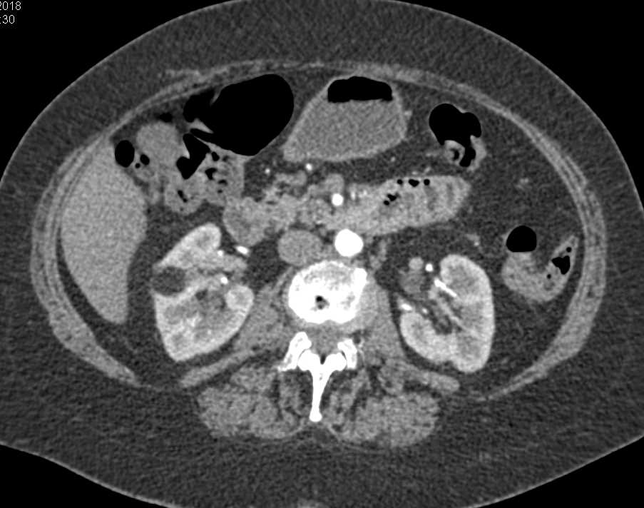 Angiomyolipoma Right Kidney - CTisus CT Scan