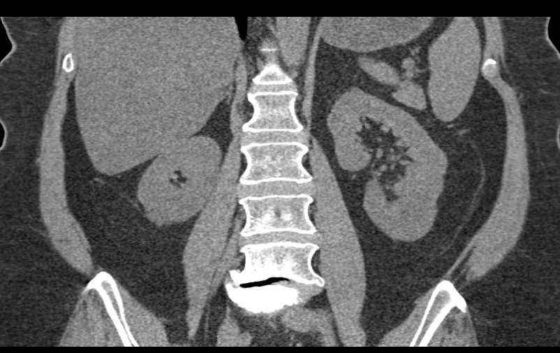 1cm RCC Upper Pole Left Kidney - CTisus CT Scan