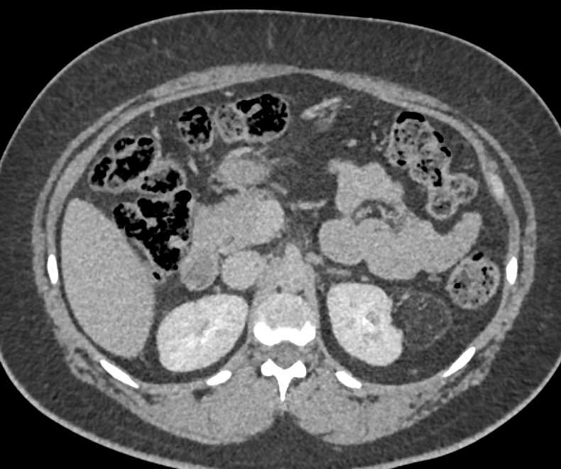 Left Renal Angiomyolipoma (AML) - CTisus CT Scan