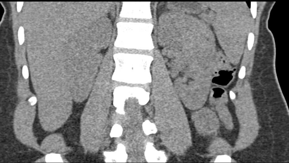 Lipid Poor Angiomyolipoma Left Kidney - CTisus CT Scan